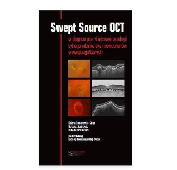 Swept Source OCT w diagnostyce patologii tylnego bieguna oka i nowotworów wewnątrzgałkowych